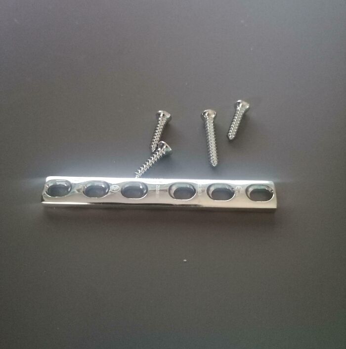 Metal bone plate and screws used in human body surgery for fixing extra finger or bone fractures.
