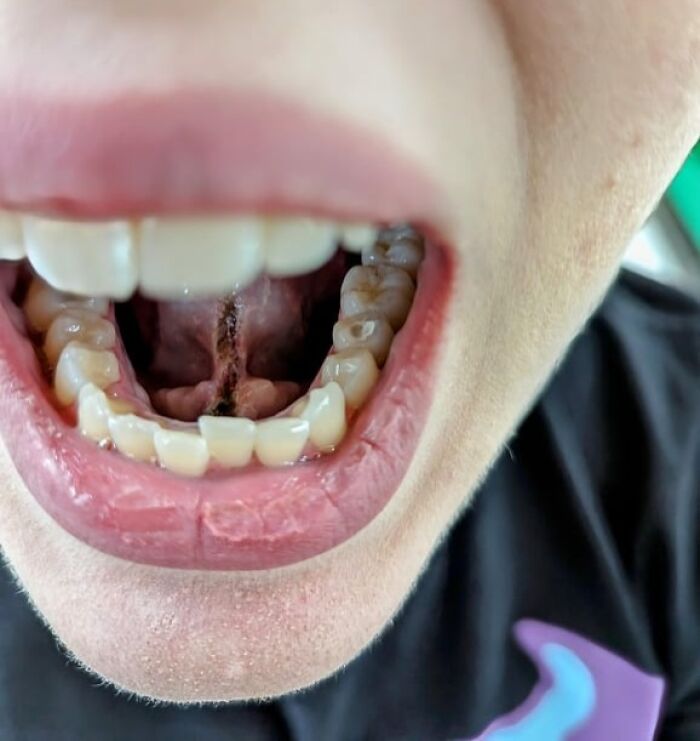 Close-up of an open mouth showing unusual dark line on the tongue, highlighting wild things happening to the human body.