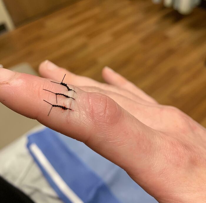 Close-up of a human finger with stitches showing a rare condition related to having an extra finger.