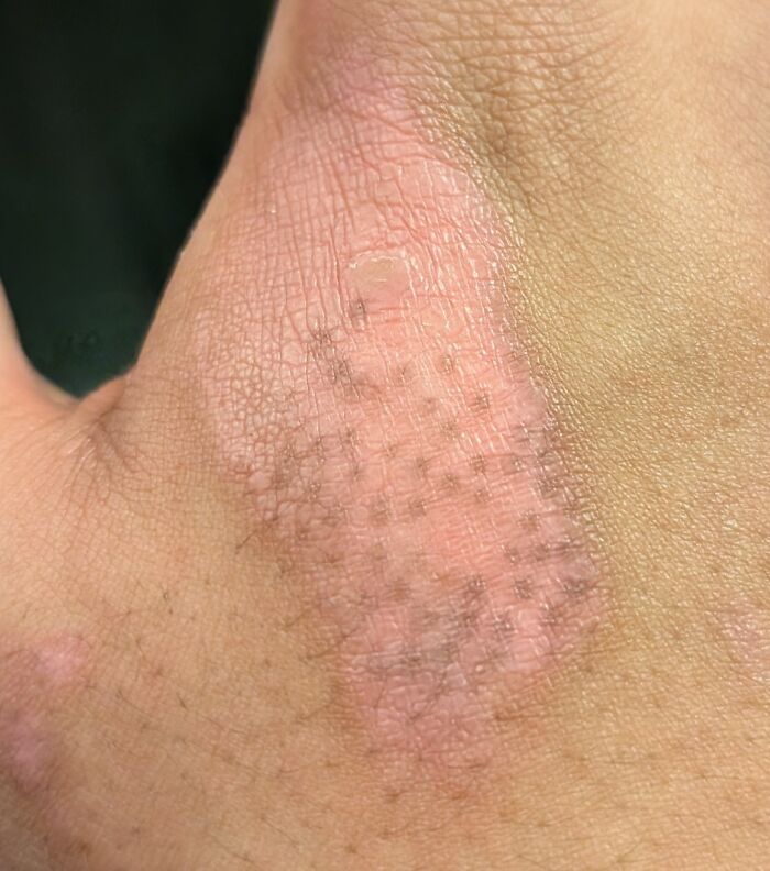 Close-up of irritated human skin showing texture and discoloration, illustrating wild things that can happen to the human body.