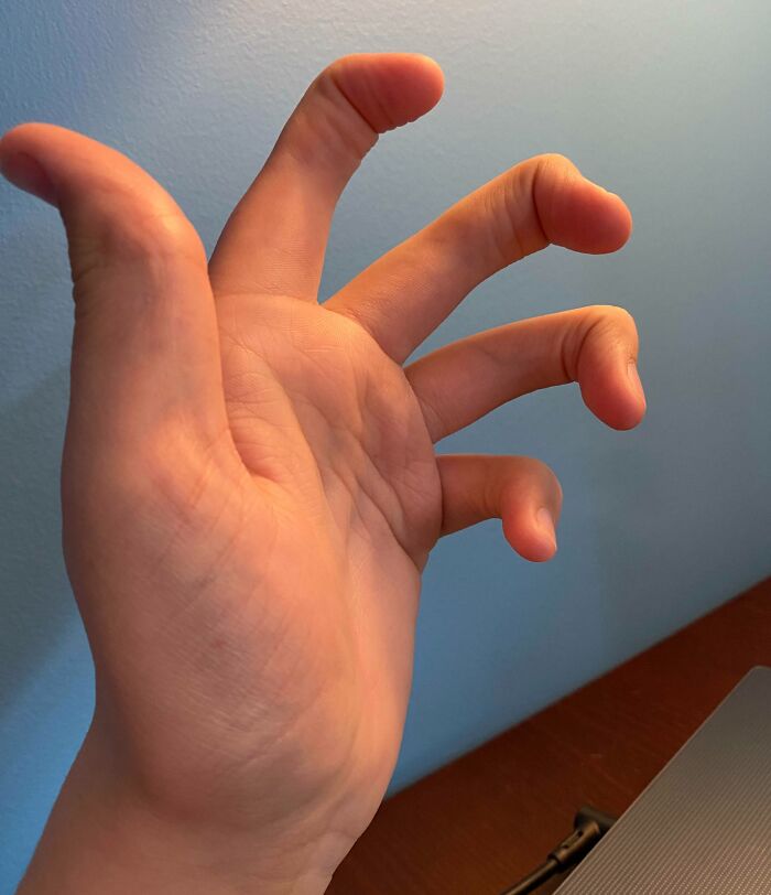 Close-up of a human hand showing an extra finger, illustrating unusual and fascinating human body variations.