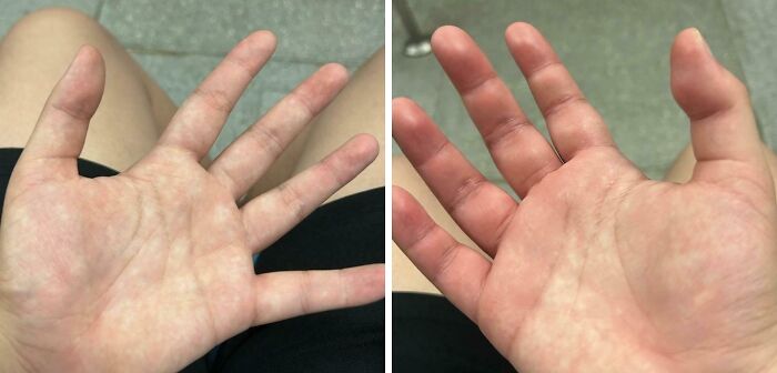 Close-up comparison of hands showing an extra finger, illustrating unusual and wild things that can happen to the human body.