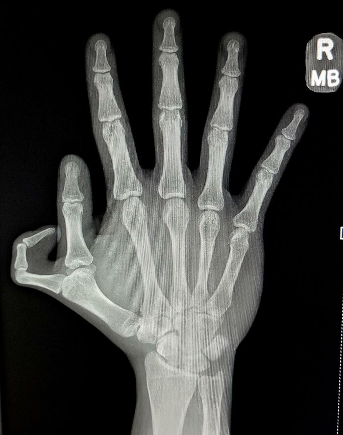 Radiografía de mano que muestra rasgos distintivos del cuerpo humano en los huesos y articulaciones.