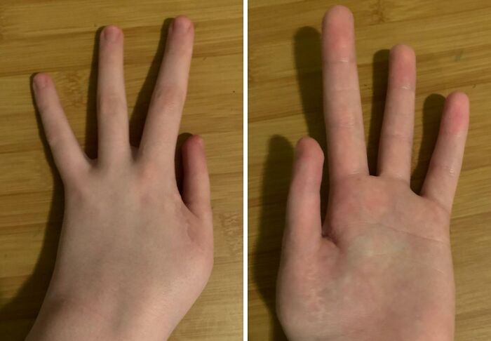 Close-up views of a human hand showing an extra finger, illustrating a rare and fascinating body anomaly.