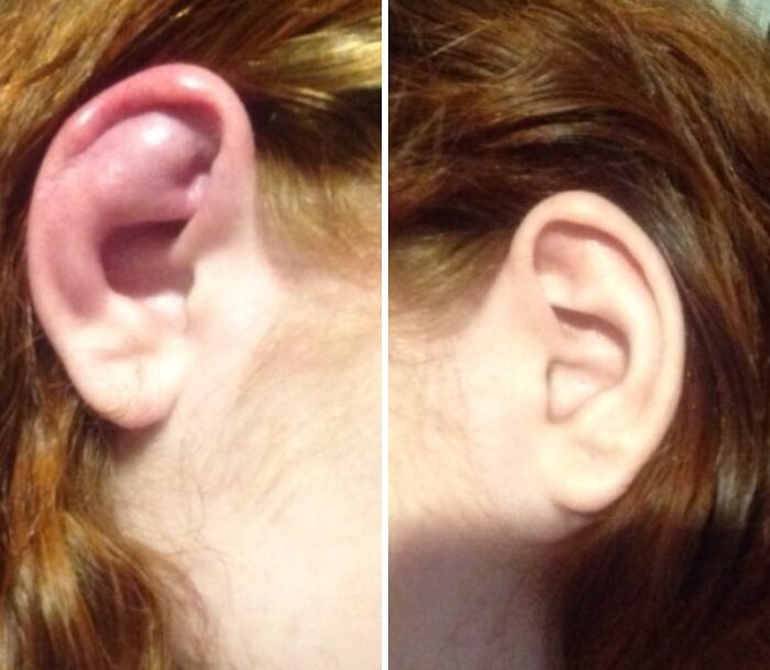 Close-up comparison of a human ear with an unusual extra fold, illustrating wild things that can happen to the human body.