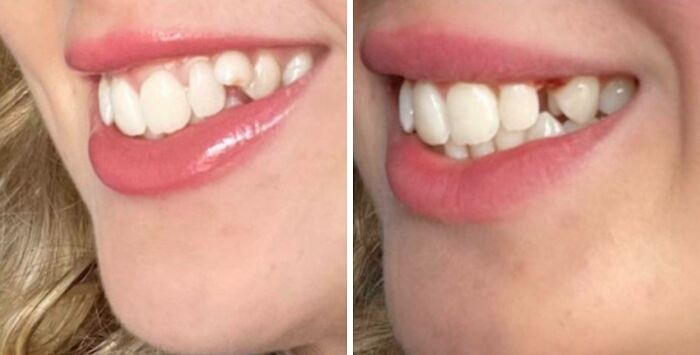 Close-up comparison of a person's mouth showing an extra tooth anomaly, highlighting fascinating human body variations.