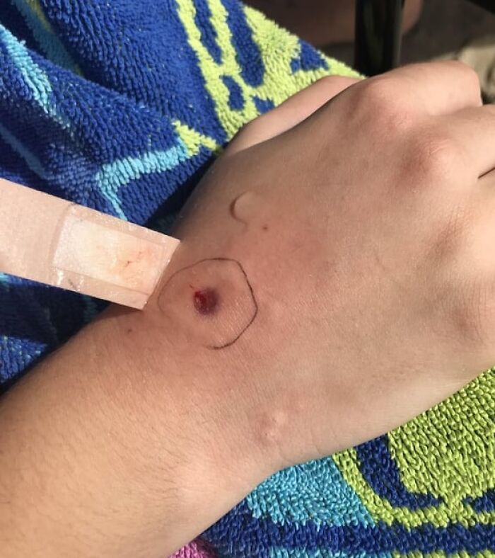 Close-up of a hand with a small wound marked on the skin, illustrating unusual human body conditions like an extra finger.