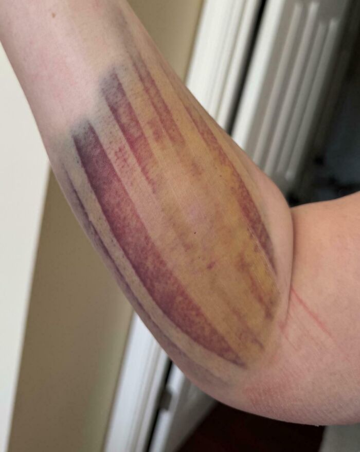 Bruised and swollen forearm showing discoloration and muscle outline, illustrating wild things that can happen to the human body.