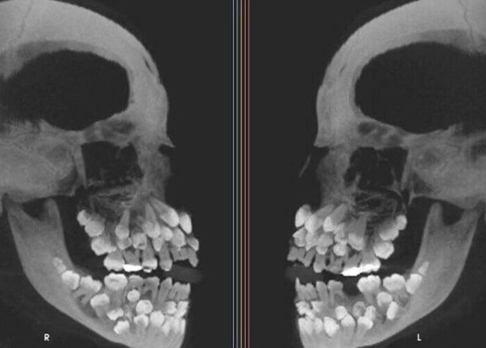 Radiografía de cráneo mostrando un rasgo distintivo del cuerpo humano con dientes supernumerarios, un rasgo que hace destacar a la gente.