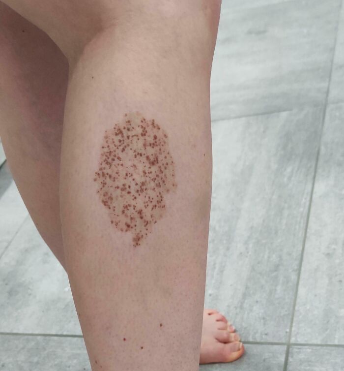 Close-up of a leg showing a large birthmark, illustrating fascinating and wild things that can happen to the human body.