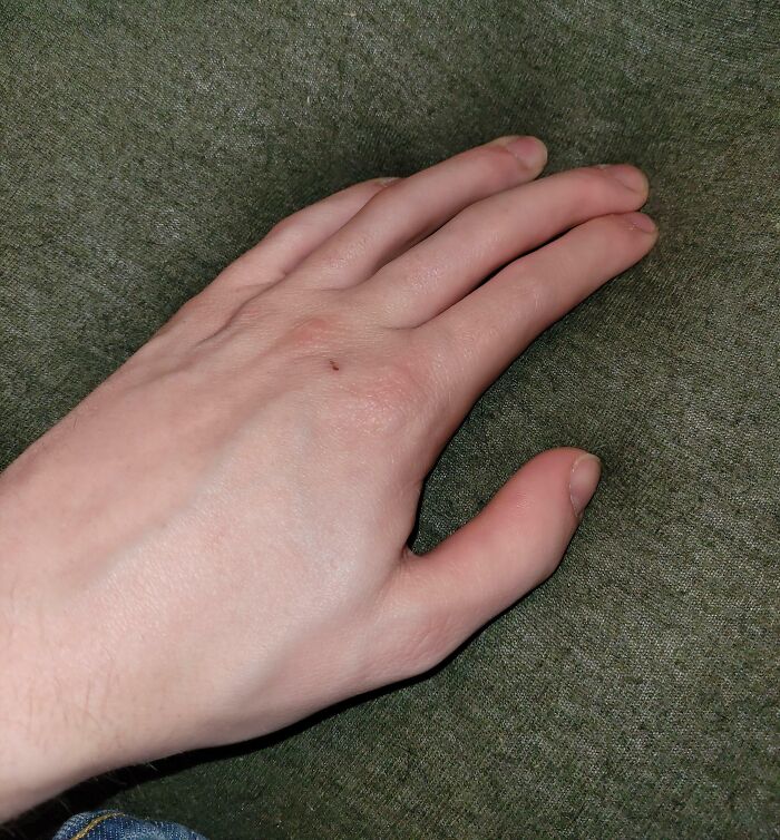Close-up of a human hand with an extra finger lying on a textured green fabric surface.