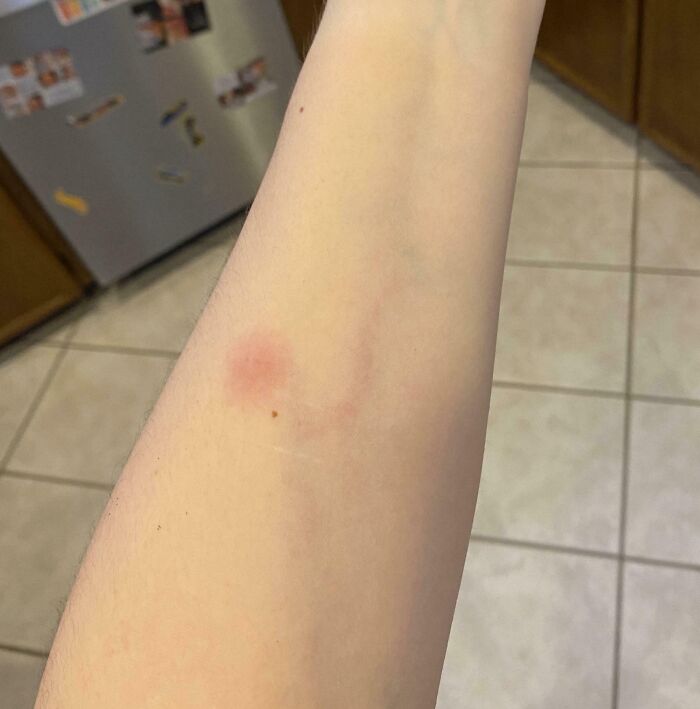 Close-up of a human forearm showing an unusual faint extra finger shape, illustrating rare body phenomena.