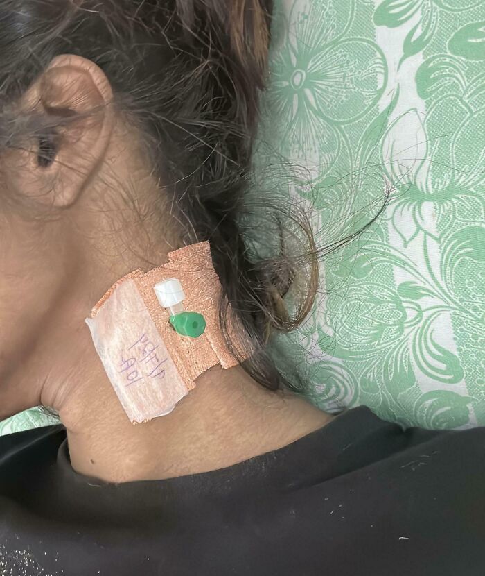 Close-up of a person's neck with medical dressing and tubing, showing a unique human body condition.