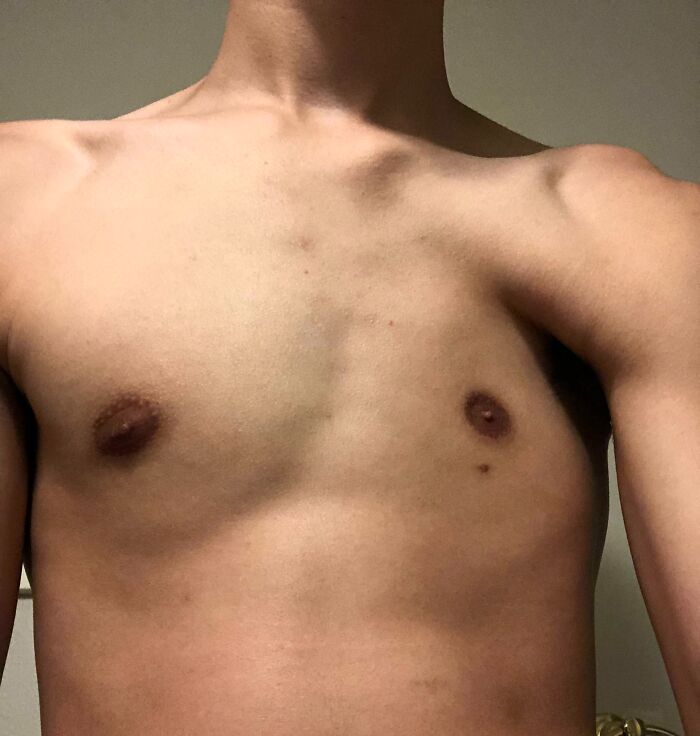 Close-up of a bare human chest showing natural skin texture and body features, illustrating unique human body traits.