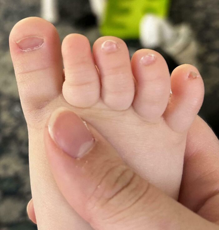 Close-up of a tiny human foot with an extra finger-like toe, showcasing a rare body anomaly in detail.