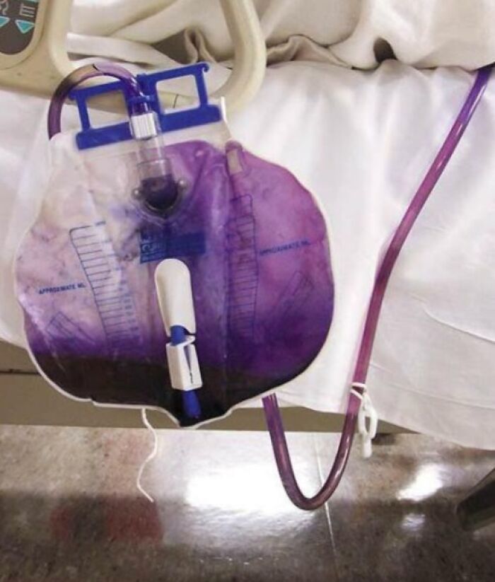 Urine bag filled with unusually purple fluid connected to a hospital bed, illustrating wild things that can happen to the human body.