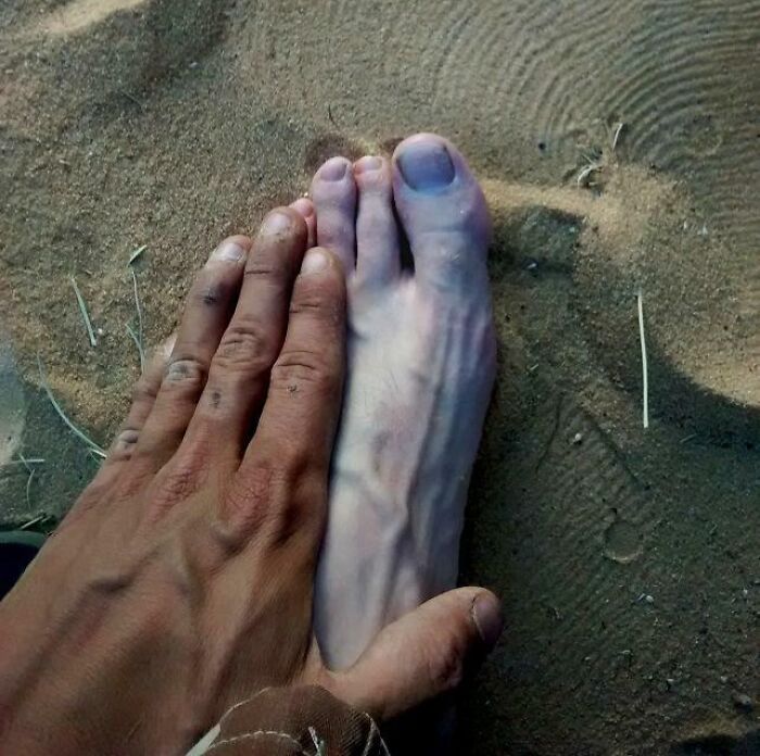 A close-up comparison of a human hand and foot, highlighting an extra finger on the foot on sandy ground.