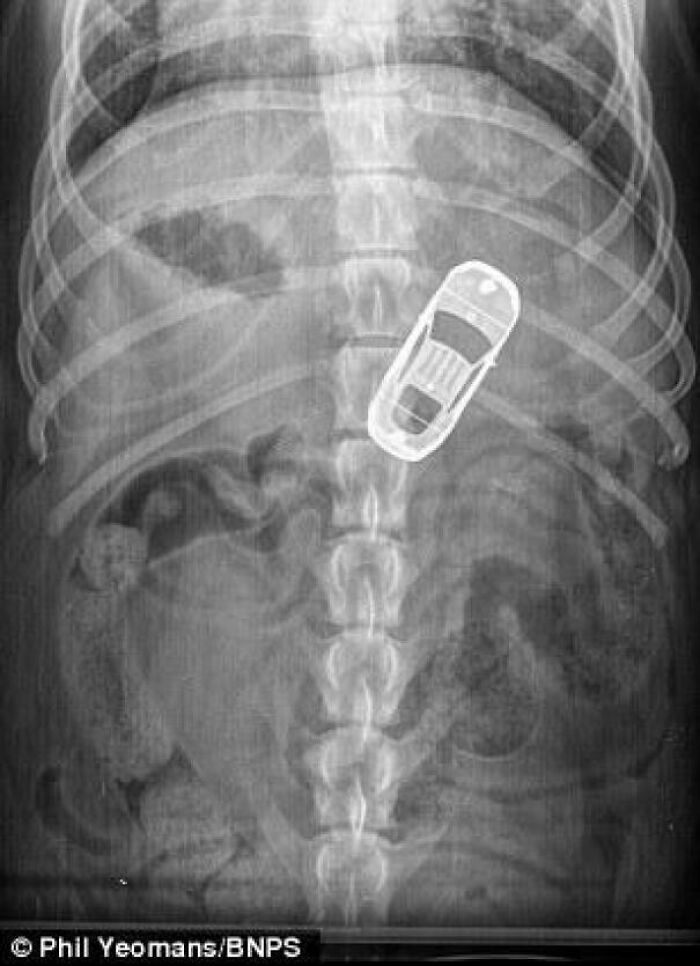 X-ray image showing a toy car inside a human abdomen, illustrating a humorous parking fail concept.