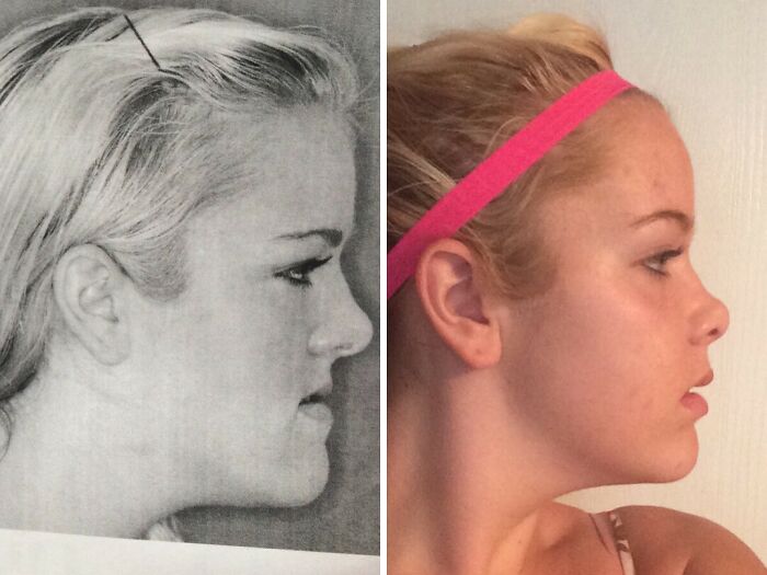 Side-by-side profile comparisons of a young woman showing changes in facial structure over time.