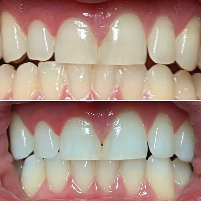 Close-up comparison of teeth before and after whitening treatment showing noticeable improvement and shine.