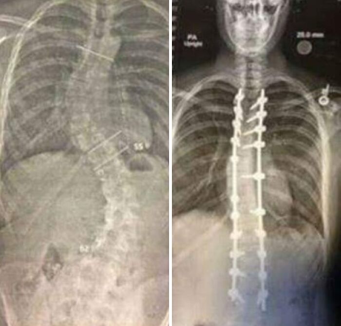 X-ray image comparison showing spinal curvature before and after surgical correction with metal implants, medical comparison.