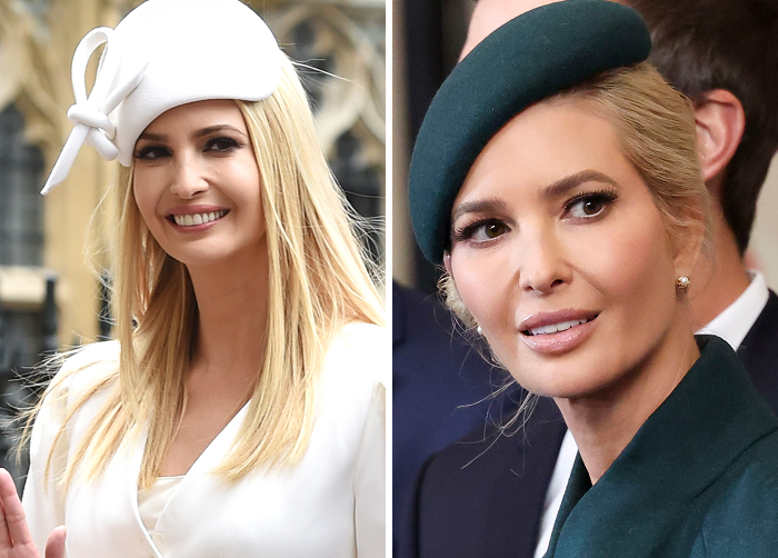 Side-by-side photos of a Ivanka Trump showcasing the difference between regular Botox and lip flip results.