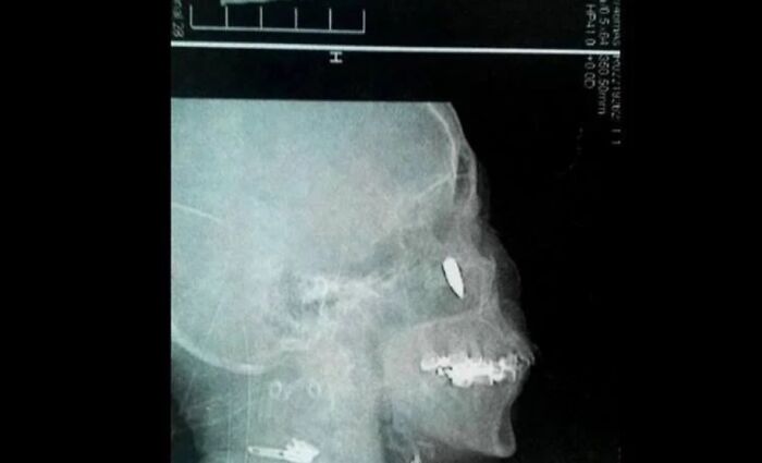X-ray image showing a skull with foreign objects embedded, illustrating unsettling images from morbid knowledge group.
