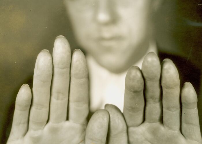 Close-up of a person showing their hands with swollen fingers in a unique historical photo capturing unusual conditions.