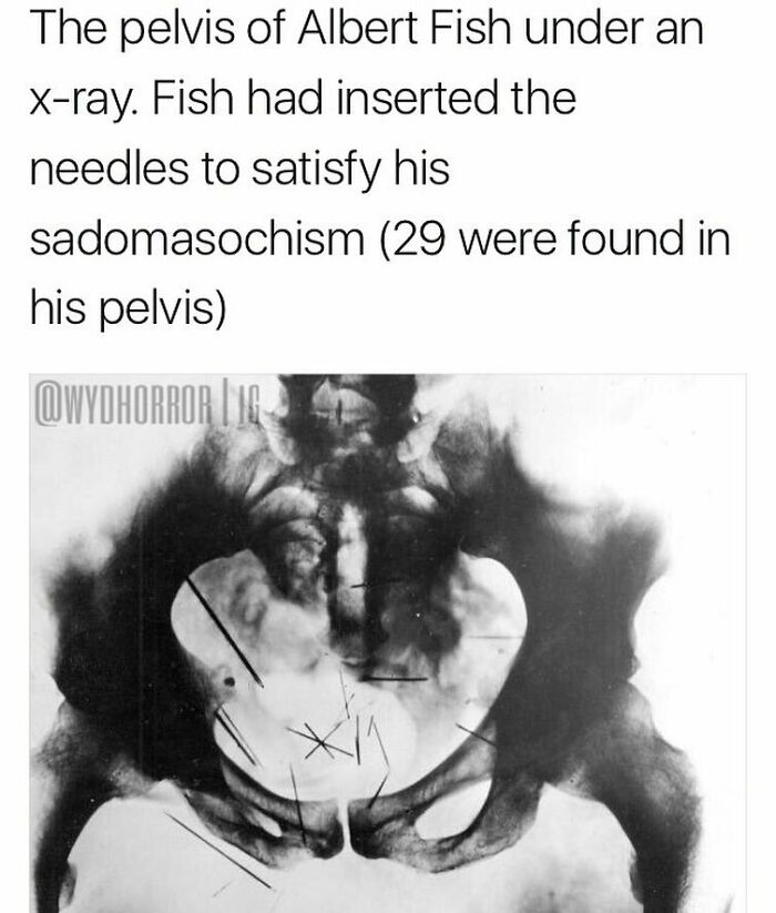 X-ray image of Albert Fish's pelvis showing needles inserted, a creepy fact from random creepy facts and pics.