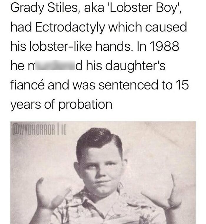 Black and white photo of a boy with ectrodactyly showing lobster-like hands, a creepy fact from the collection.