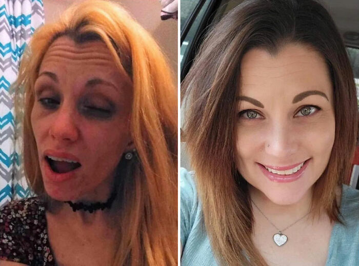 Side-by-side before and after photos showing a woman recovering and rebuilding her life with a brighter and healthier appearance.