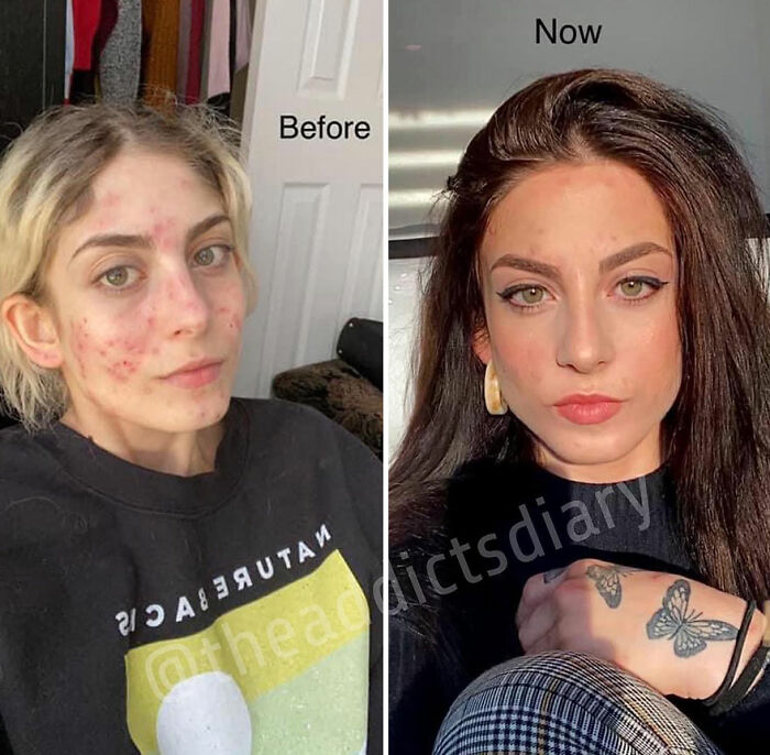 Before-and-after pics of a woman’s skin recovery and transformation, showing rebuilding and healing progress.