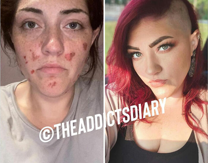 Side-by-side before-and-after photos showing a woman’s recovery and rebuilding her life with improved skin and confidence.
