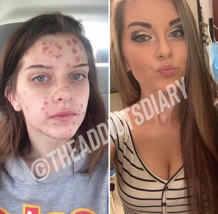 Before-and-after pics showing a woman recovering and rebuilding her life with clear skin and confidence transformation.