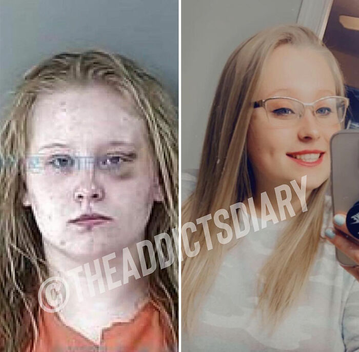 Side-by-side before and after photos showing a woman recovering and rebuilding her life with clear skin and a smile.