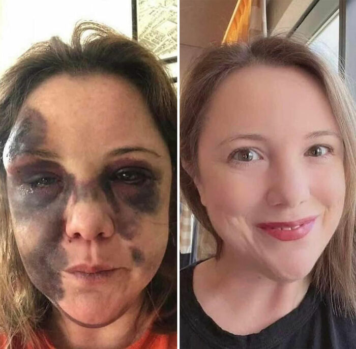 Woman recovering and rebuilding her life shown in before and after photos with healing facial bruises and a bright smile.