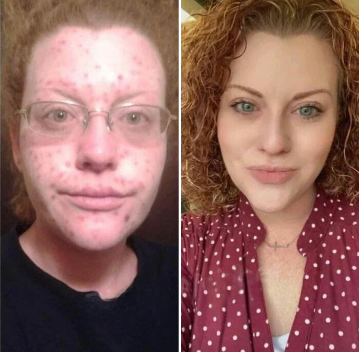 Before-and-after pics of a woman recovering from severe acne, showing clear skin and confident expression rebuilding her life.
