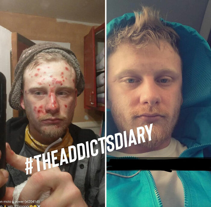 Before-and-after pics showing a young man recovering and rebuilding his life from a*******n and skin issues.