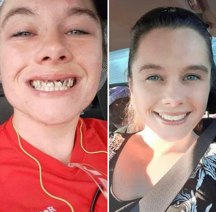 Before-and-after image showing a person recovering and rebuilding their life with a transformed smile and confidence.