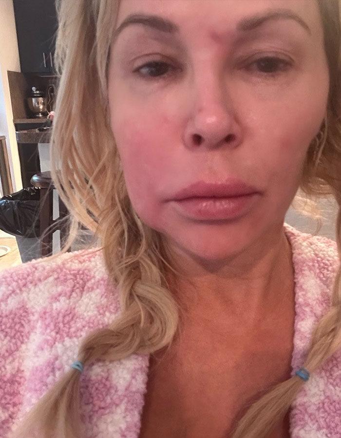 Brandi Glanville Reveals New Smile After $130K Health Battle And Face-Disfiguring Parasite Brandi Glanville Reveals New Smile After $130K Health Battle And Face-Disfiguring Parasite