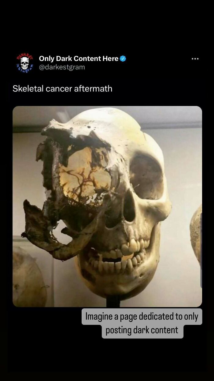 Skull with severe skeletal damage displayed on a dark Instagram page sharing creepy spooky stories.