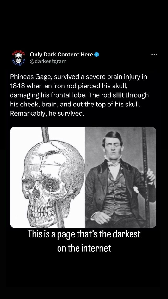 Post from darkest page on Instagram about Phineas Gage's survival after a severe brain injury with iron rod through skull.
