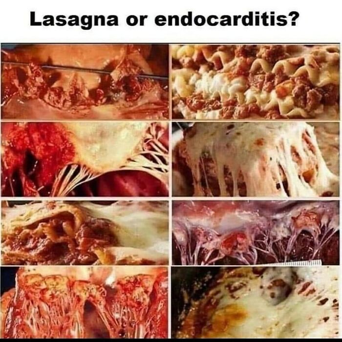 Close-up images comparing cheesy lasagna and heart tissue with endocarditis showing funny and relatable medical memes.