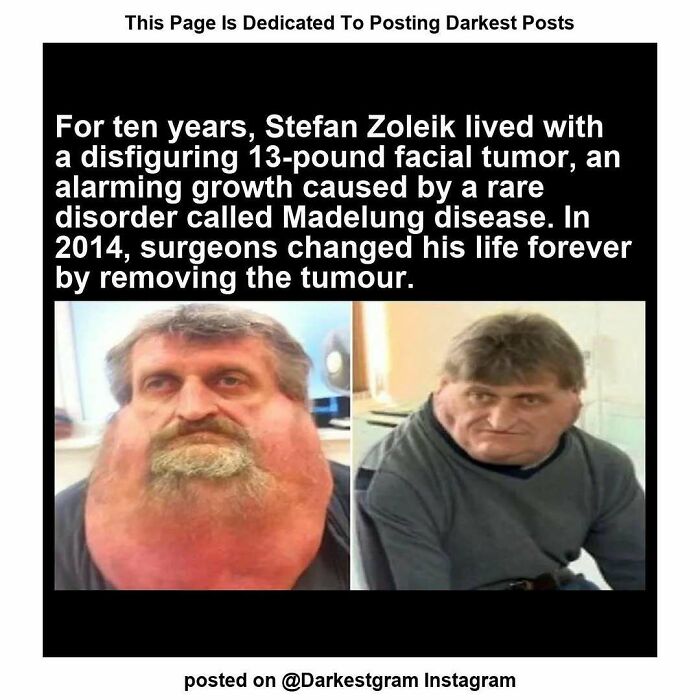 Before and after photos of a man with a massive facial tumor, illustrating darkest page on Instagram’s creepy stories.