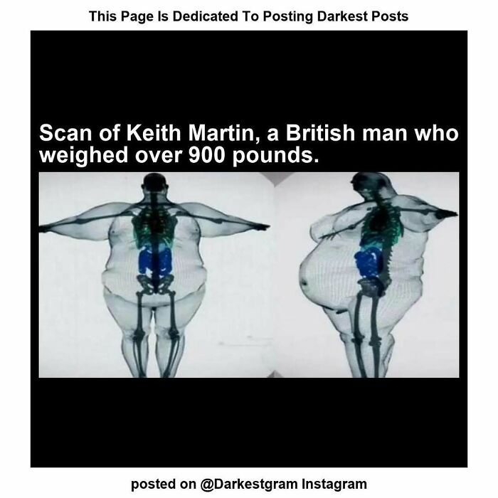 Scan showing skeletal structure and body shape of a man weighing over 900 pounds from darkest page on Instagram.