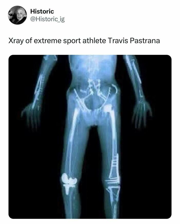 Xray image of extreme sport athlete with multiple bone surgeries shown in historic photos collection
