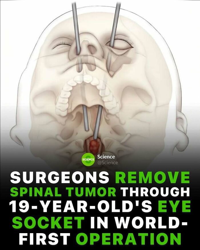 Illustration showing spinal tumor removal through a 19-year-old’s eye socket in a groundbreaking science operation.