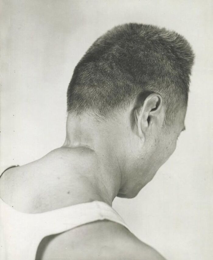 Black and white historical photo showing a man's profile with a pronounced neck bump, part of historical photos and backstories.