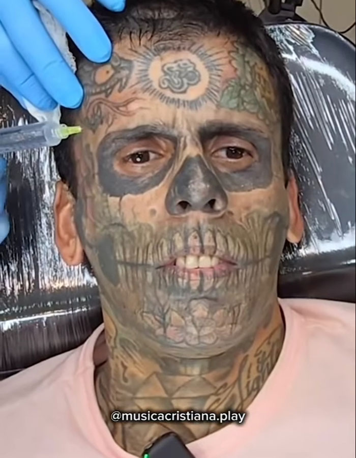 95% tattooed Brazilian Steve-O undergoing a dramatic new look with tattoo removal treatment on his face and neck.