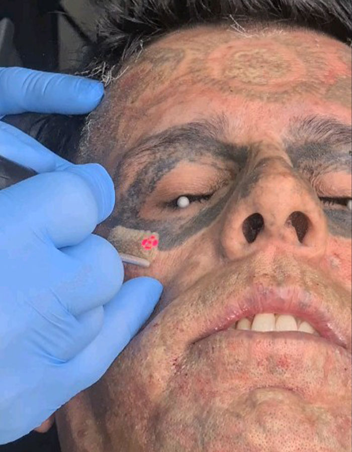 Close-up of Brazilian Steve-O 95% tattooed man undergoing tattoo removal on his face, revealing a dramatic new look.